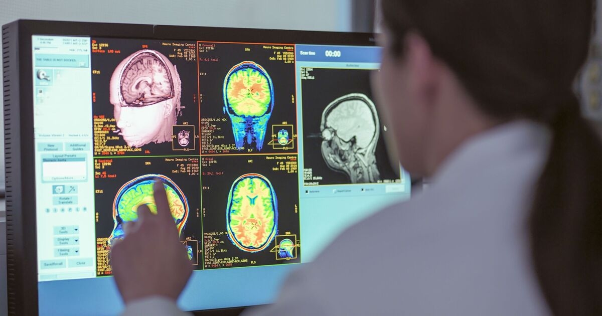 Dos medicamentos contra el cáncer podrían revertir los cambios cerebrales del Alzheimer: estudio completo explicado