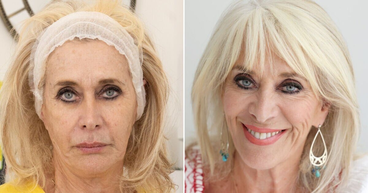 I lost 4 stone on Ozempic at 70 but it caused one problem with my face