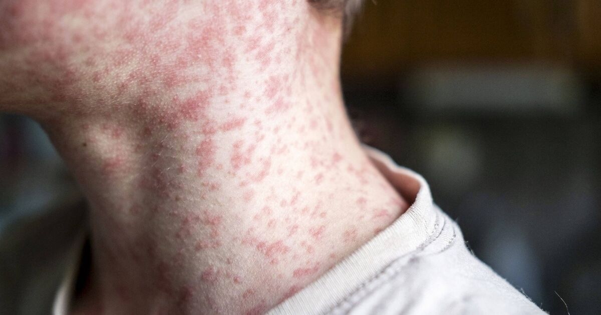 UK holidaymakers alerted after measles outbreak in Spanish tourist hotspot