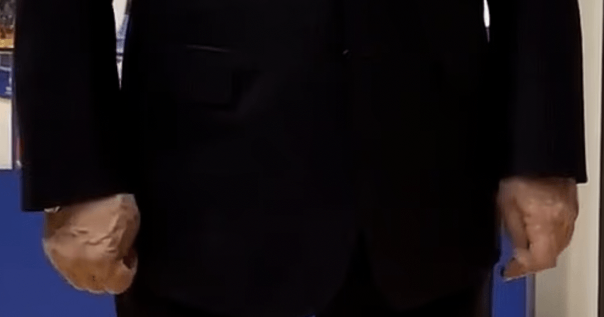 Putin'in sağlık endişeleri, şişmiş damarların 'aşırı derecede ağrılı' görünmesinden kaynaklanıyor