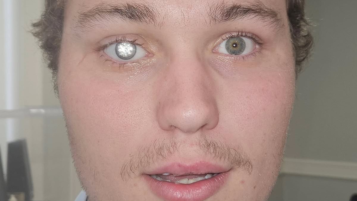 Ein echter Bond-Bösewicht! Der Juwelier hat einen 2-Karat-DIAMANT in sein künstliches Auge eingesetzt