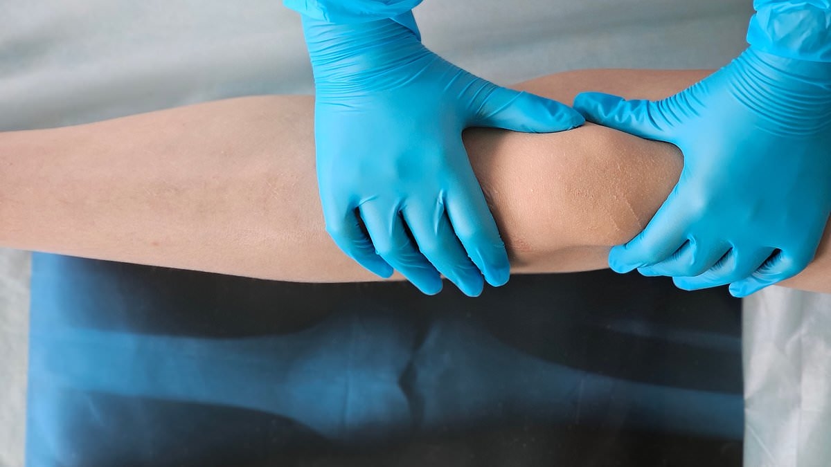 Calcium and Vitamin D supplements taken by millions DON'T prevent painful bone fractures and falls, study finds - BMJ