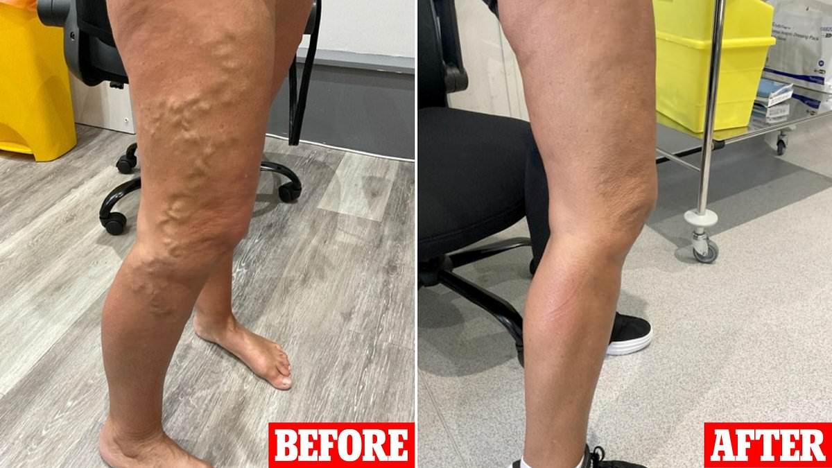 The pioneering procedure that banishes painful and unsightly varicose veins for good... it can be life-changing and it takes only 15 minutes