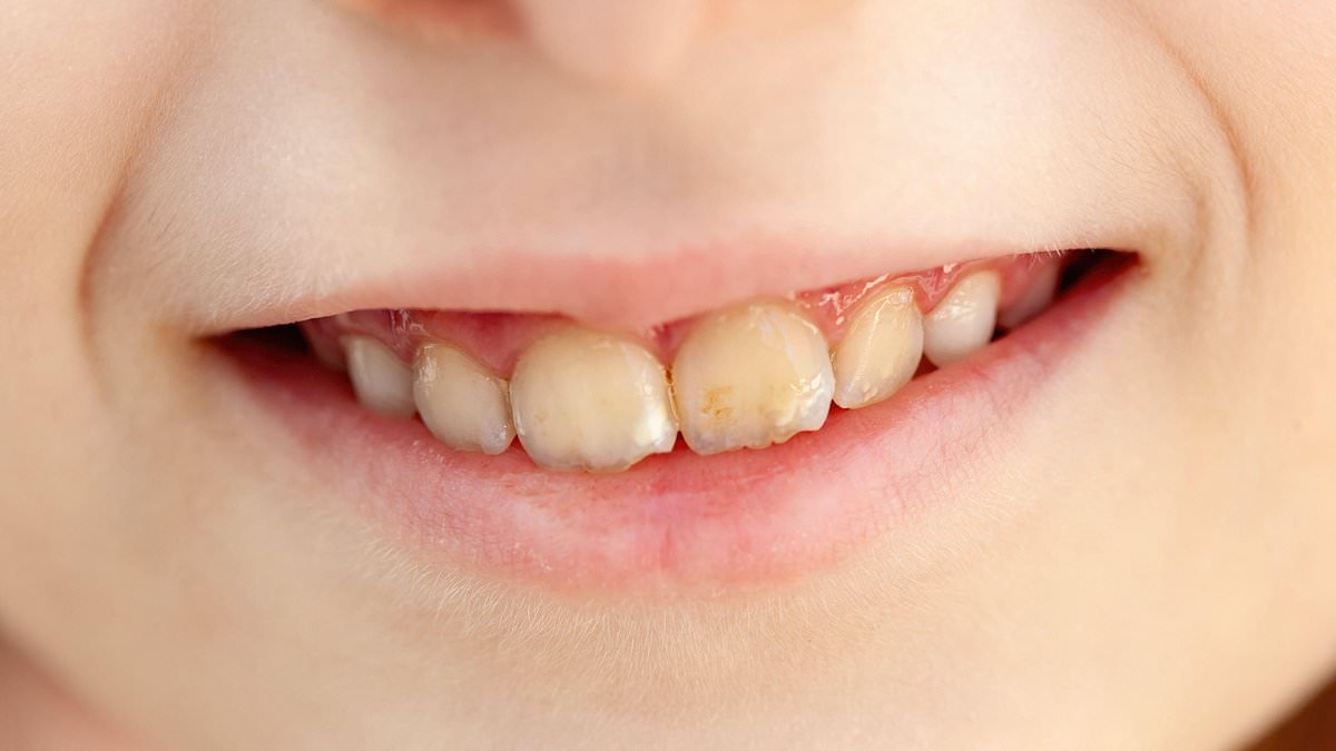 What's behind the alarming rise in a mystery dental condition that's leaving children's teeth discoloured and crumbling?