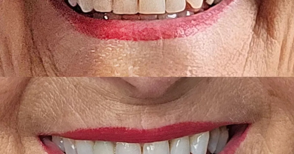 Kit de clareamento dental que deixou o sorriso de uma senhora de 77 anos 'incrível' está com 20% de desconto
