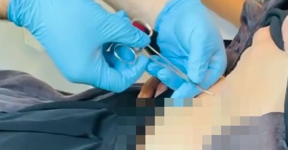 Il est allé à l'hôpital se plaignant de faiblesse ! Une tique est sortie de son estomac.