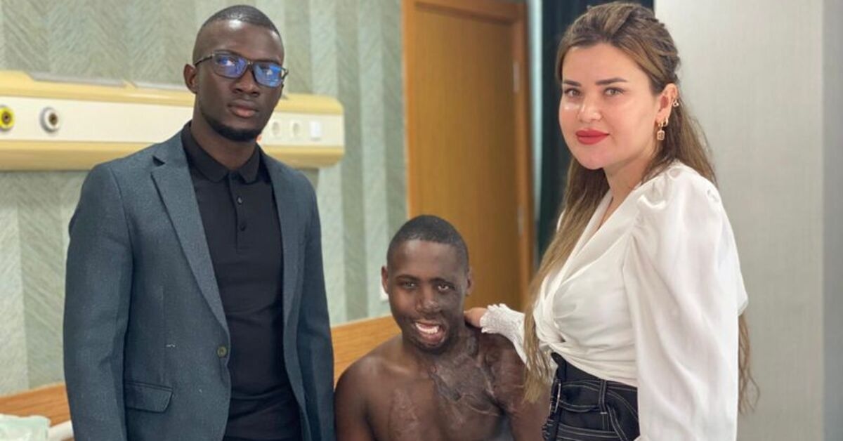 Ugandan shepherd whose face was burned receives treatment in Ankara