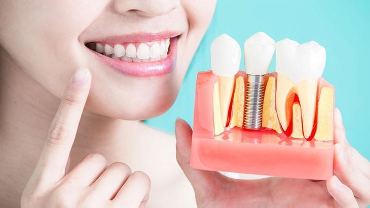 Jeder Zahnverlust erfordert ein Implantat! Zahnlosigkeit führt zum Abbau des Kieferknochens.