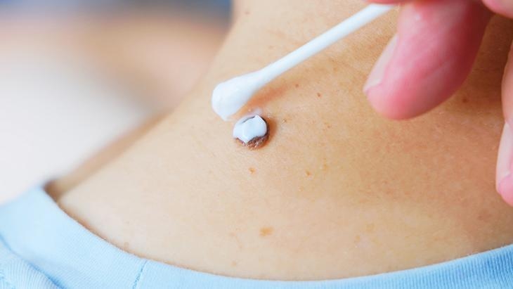 Niektórzy usuwają znamiona laserowo, inni za pomocą roztworów! „Nie każdy znamię jest nieszkodliwe, trzeba je zbadać”