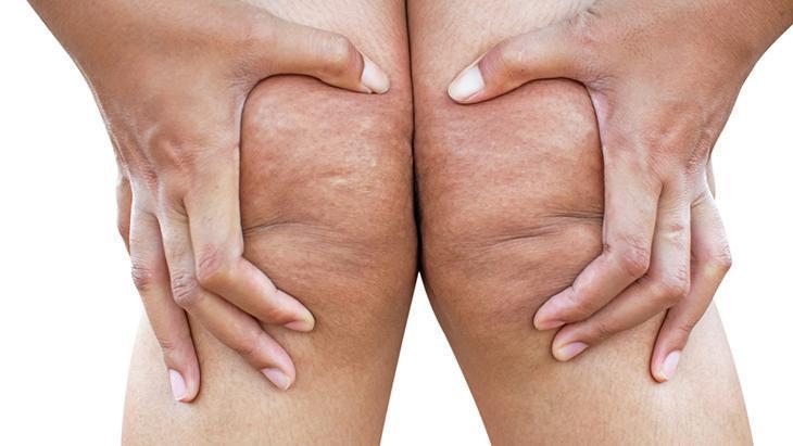 Lipedema to cichy krzyk kobiet! Odpowiedź dla tych, którzy pytają: „Dlaczego nie mogę schudnąć?”