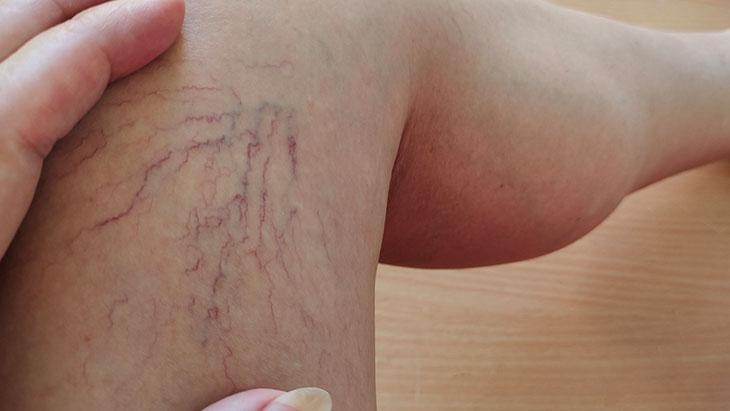 Das kommt in den letzten Jahren immer häufiger vor! Solche Fehler begünstigen Krampfadern.