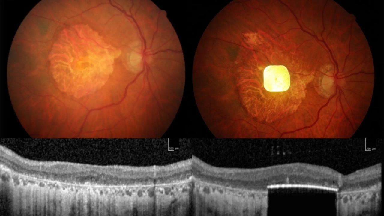 Uma prótese ocular restaura a visão de pessoas com cegueira irreversível.