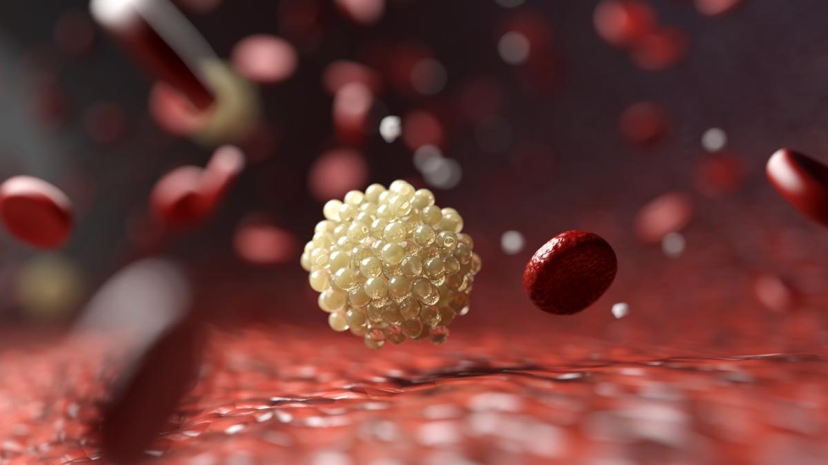 Des chercheurs parviennent à réduire le « mauvais » cholestérol de près de moitié grâce à une thérapie combinée avec un nouveau médicament.