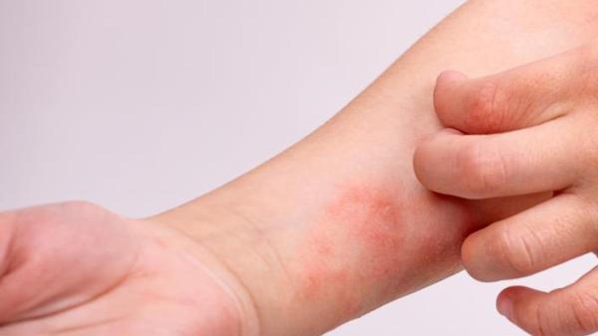 Amerika kıtaları kızamıksız statüsünü kaybetti; virüs Kanada'da yeniden endemik olarak dolaşıyor: PAHO aşılama çalışmalarının artırılması çağrısında bulundu