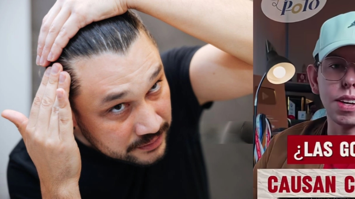 ¿Si utiliza gorra se puede quedar calvo? Expertos en dermatología responden a varios mitos sobre la alopecia