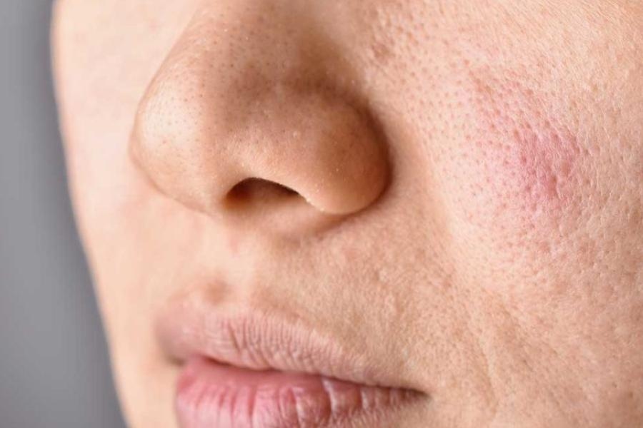 In che modo lo stress influisce sulla salute della pelle e come puoi prendertene cura?