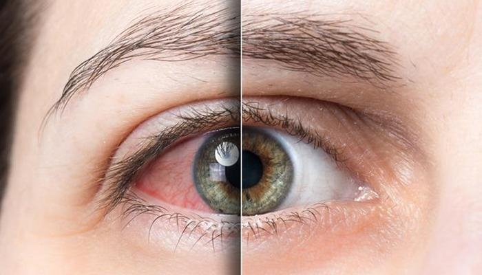 Ne sous-estimez pas votre santé oculaire ! Finies les brûlures et les picotements : « La sécheresse oculaire nuit à la qualité de vie »