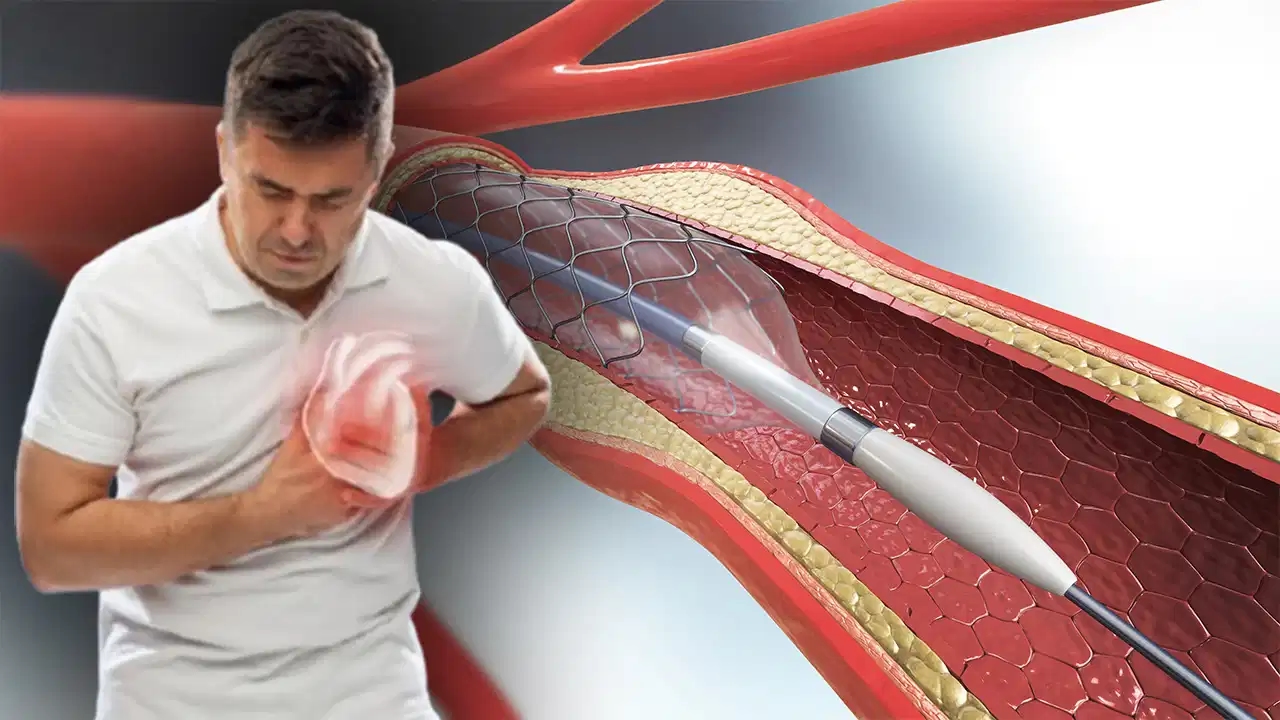 Experts warn: Fear of stents can cost you your life!