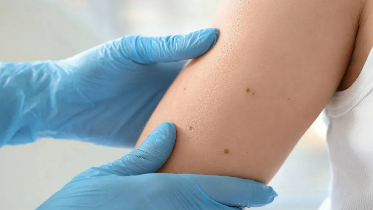 'Take necessary precautions against sun to protect yourself from skin cancer'