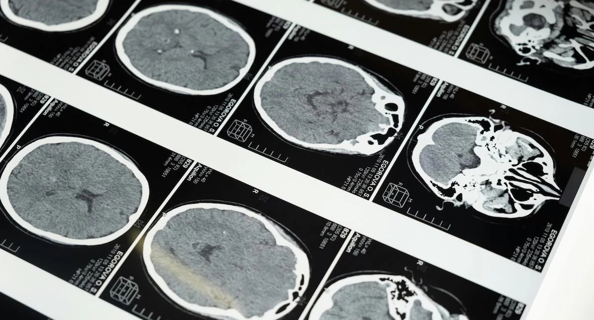 Un cervello che invecchia può essere il presagio della schizofrenia. Gli scienziati hanno scoperto un biomarcatore