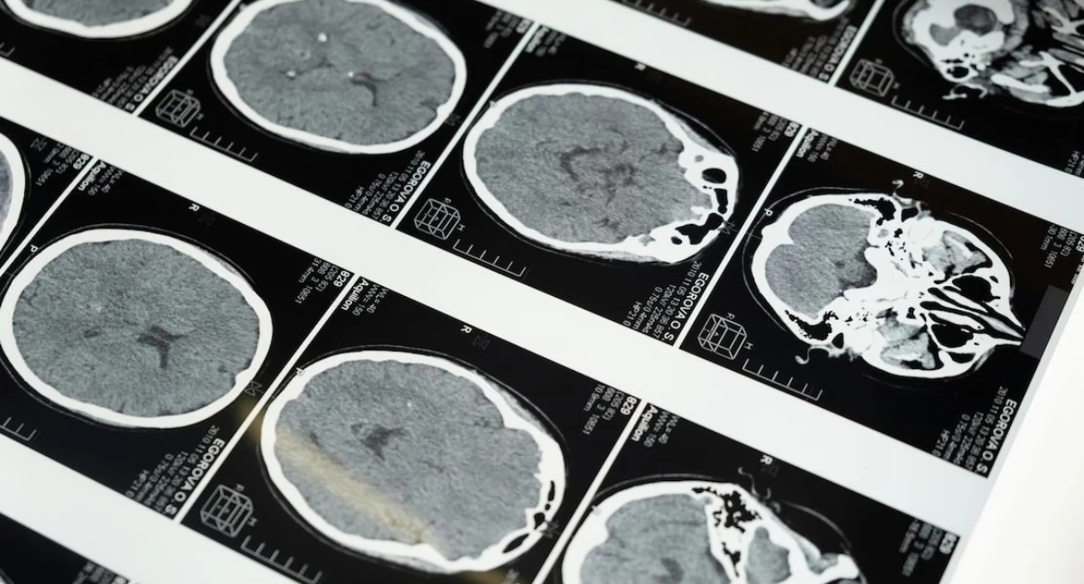 Nieuwe methode voor het testen van reuk en zicht biedt hoop op eerdere diagnose van de ziekte van Parkinson