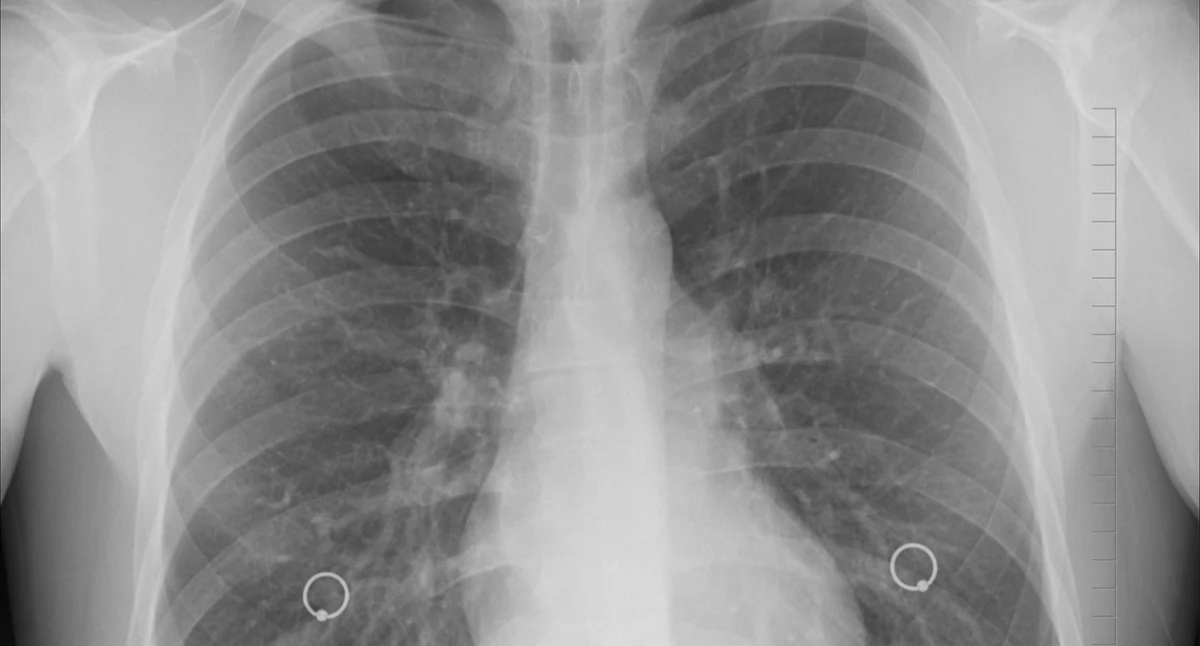Algoritme-ondersteunde radiotherapie: AI verbetert de nauwkeurigheid van longkankerbehandeling