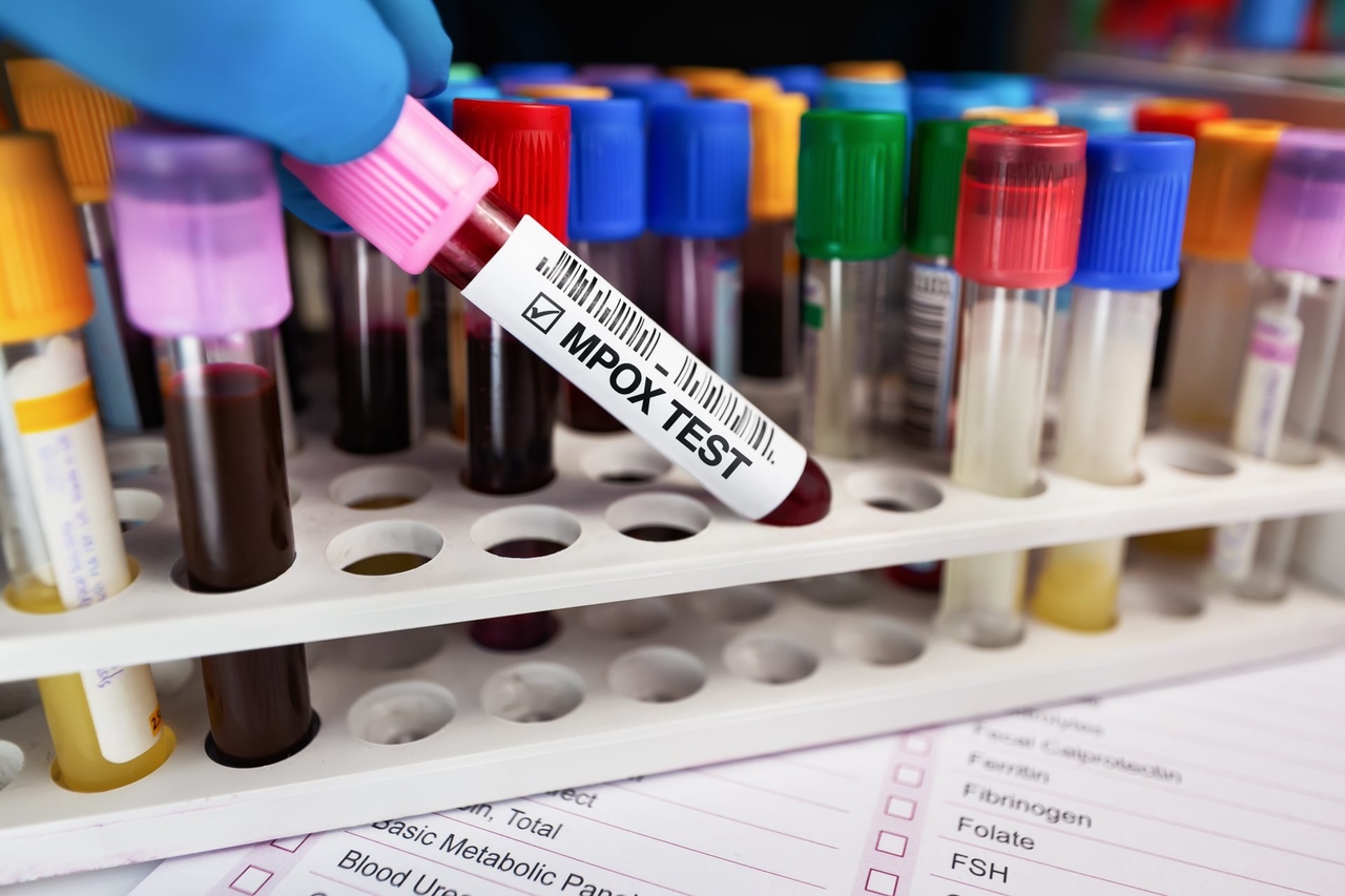 Geval van Mpox-infectie vastgesteld bij niet-ingezeten gebruiker
