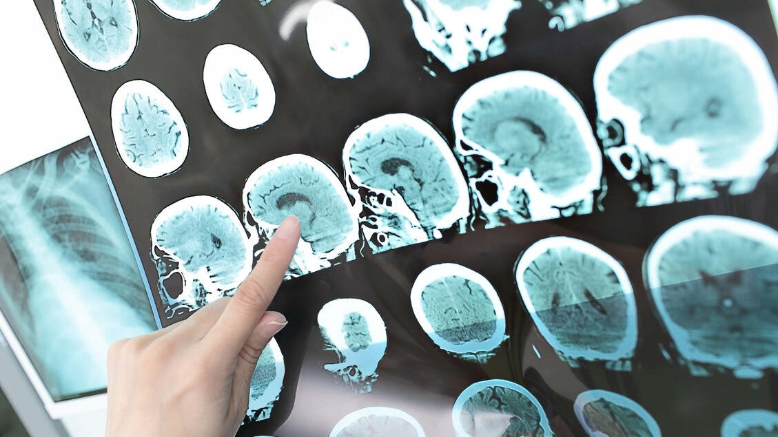 Dall'Iss linee guida per diagnosi e cura di 2 effetti dell'ictus