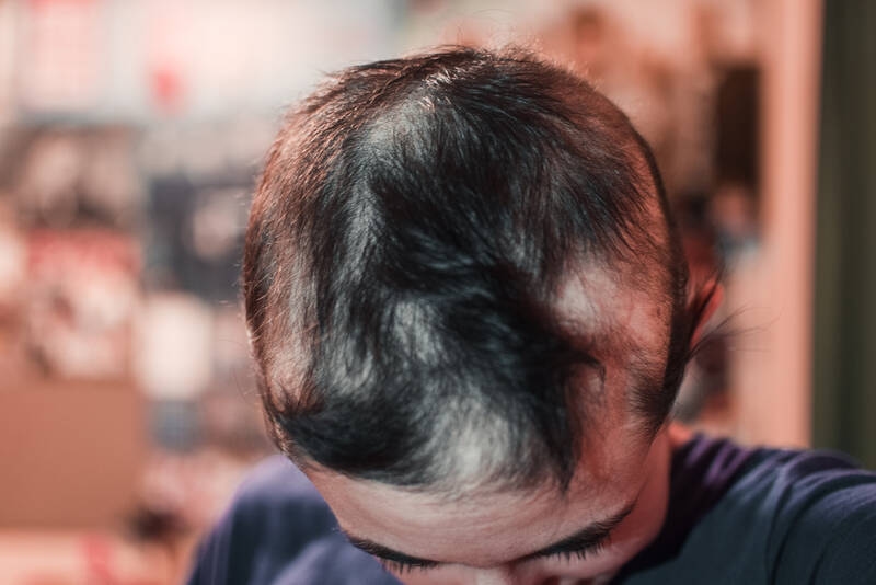 Kreisrunder Haarausfall: Topische Corticosteroide meist erste Wahl