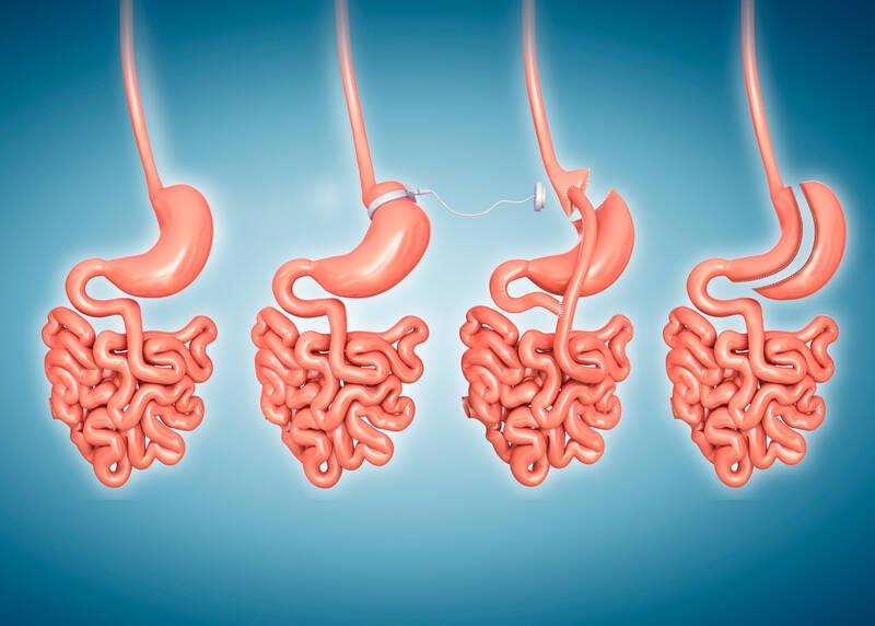 Бариатрическая хирургия: для кого и как?