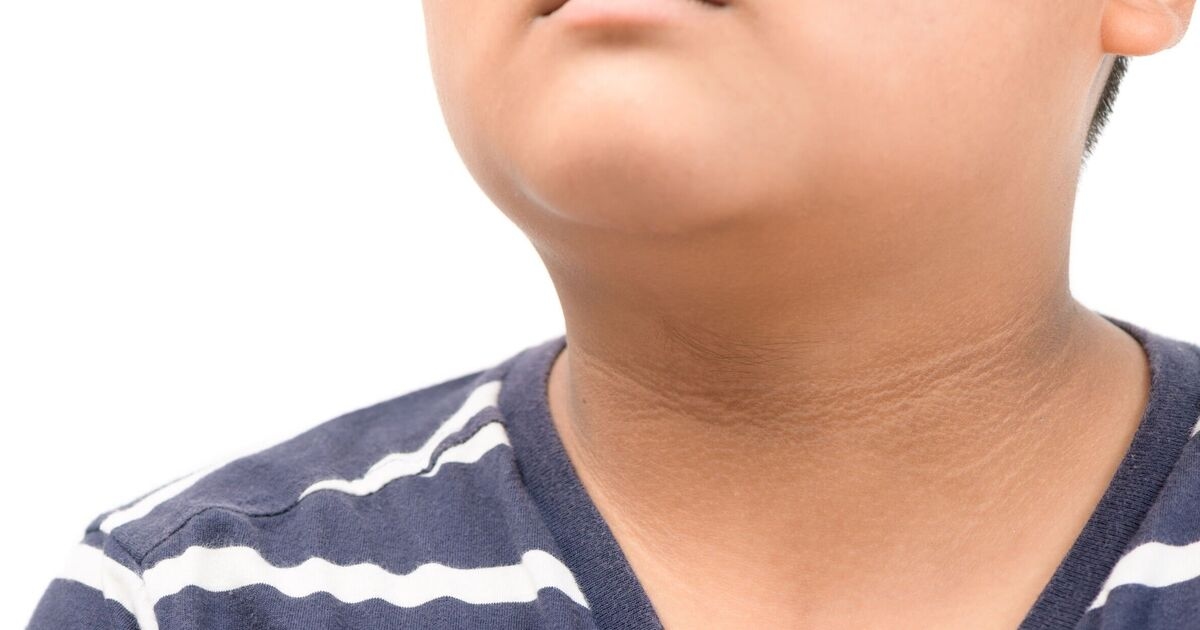 'Little-known' skin change in children could be early sign of diabetes