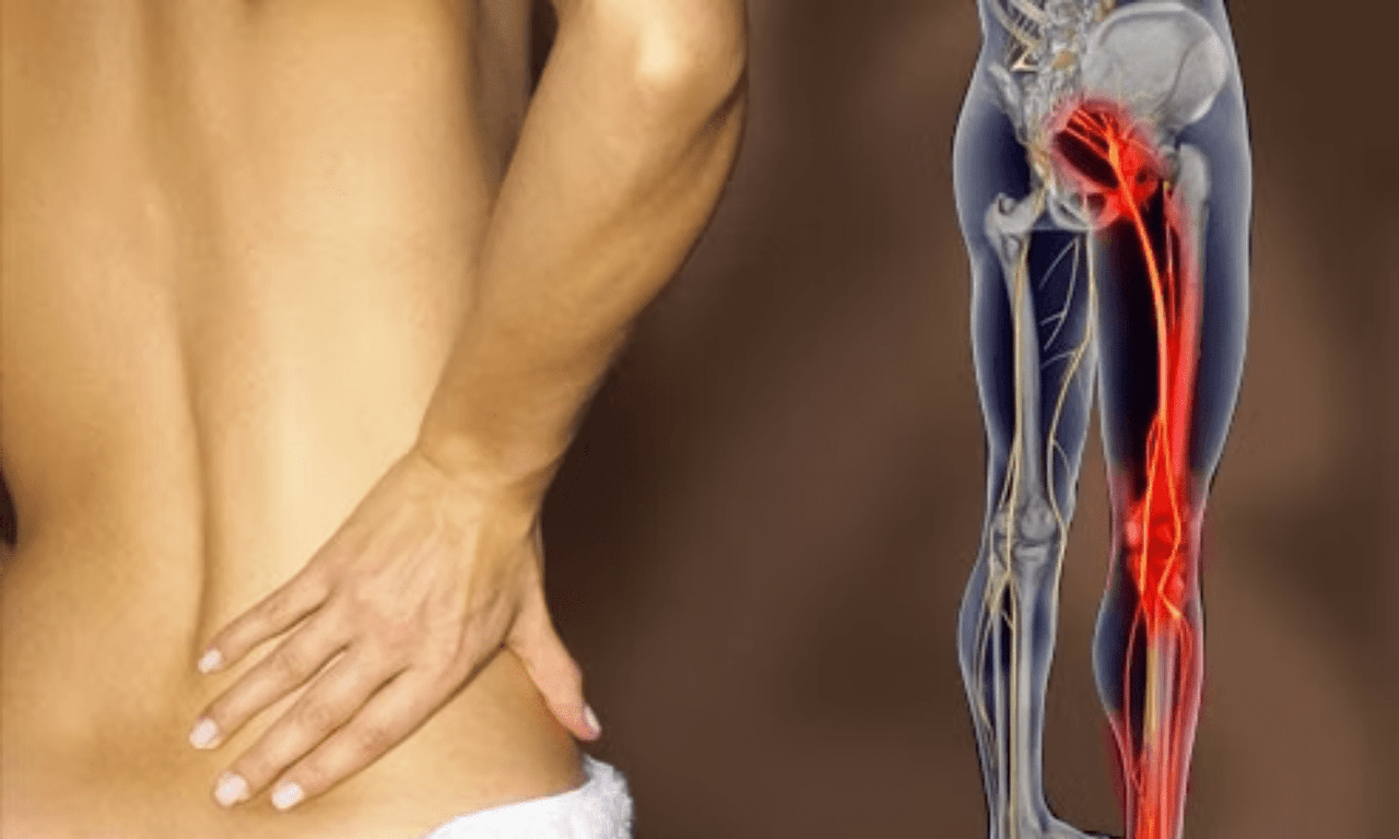 Боль в седалищном нерве: как ее распознать, что ее вызывает и как ее облегчить