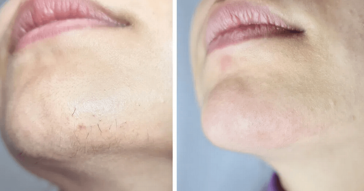Shoppers say hair removal device 'results speak for themselves' and it's £140 off