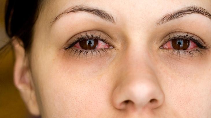 Die Winterkälte macht sich auch in den Augen bemerkbar! Sie kann ansteckend sein, daher sollten Sie Folgendes tun, wenn Sie Symptome haben.