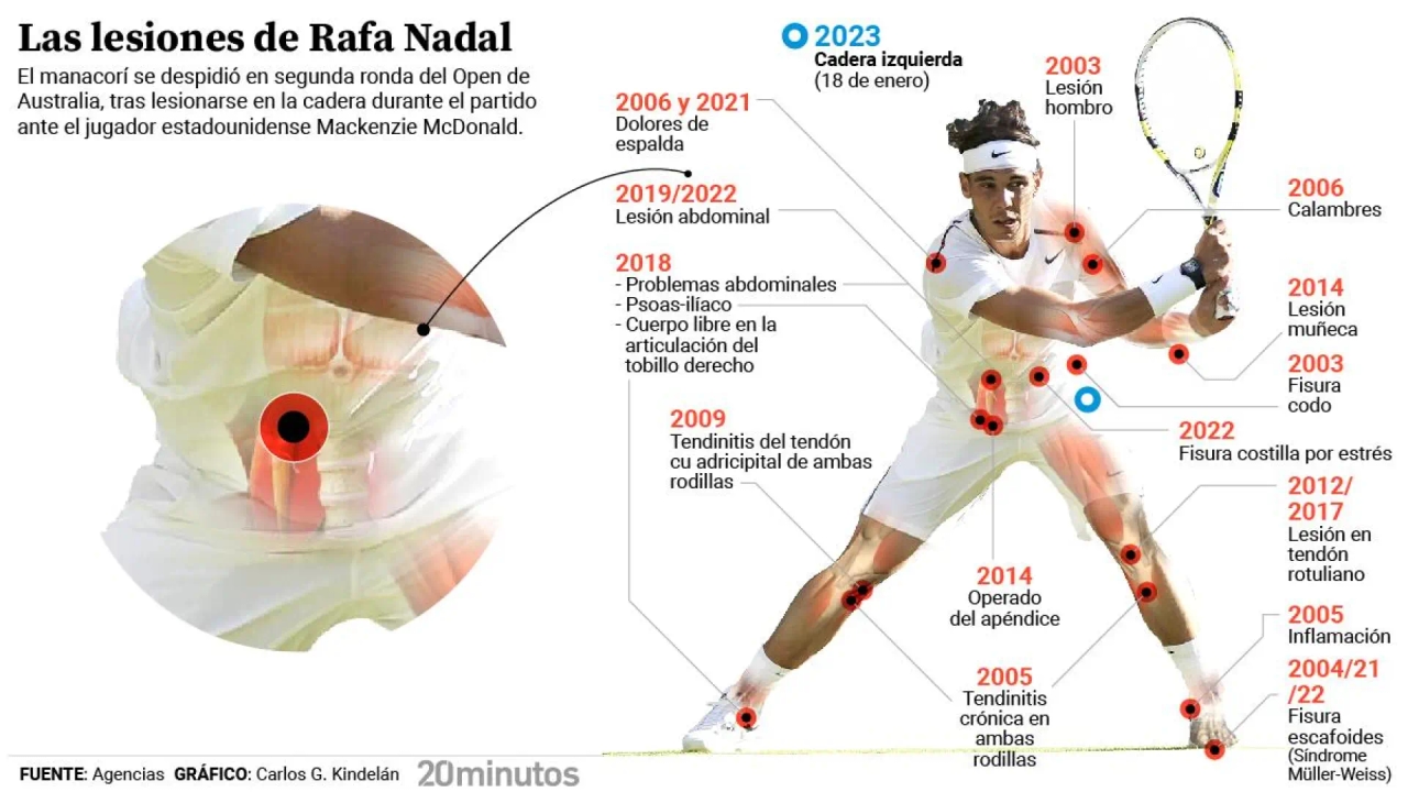 ¿Qué es el síndrome de Müller-Weiss? Causas, síntomas y tratamiento de esta enfermedad que ha marcado la vida de Rafa Nadal