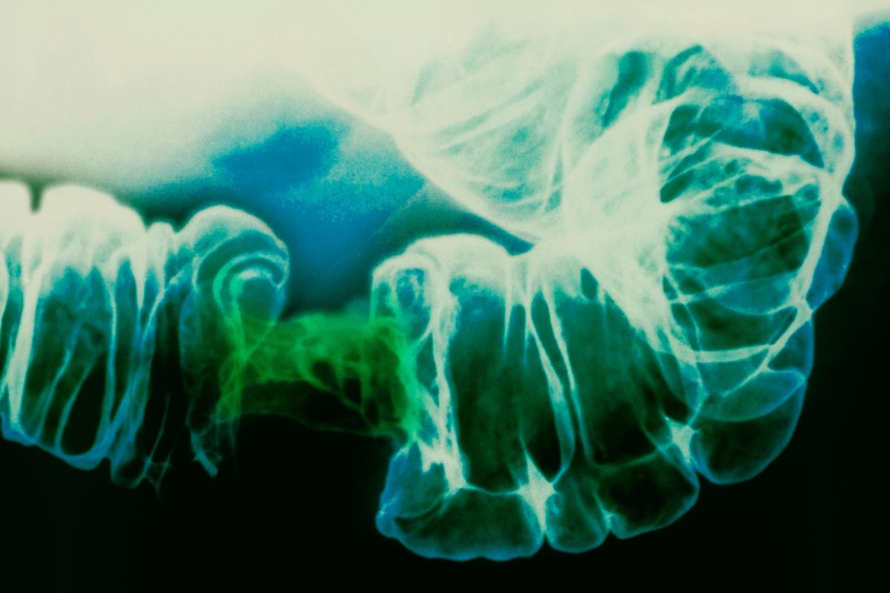 L’aspirine réduit de moitié le risque de récidive dans une forme courante de cancer colorectal