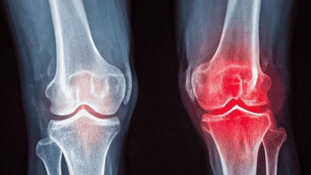 Is Surgery the Last Option for Knee Osteoarthritis? Modern Injection Therapies and the Role of Exercise