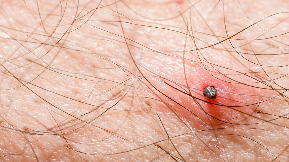 Spring weather leads to a surge in tick bites nationwide